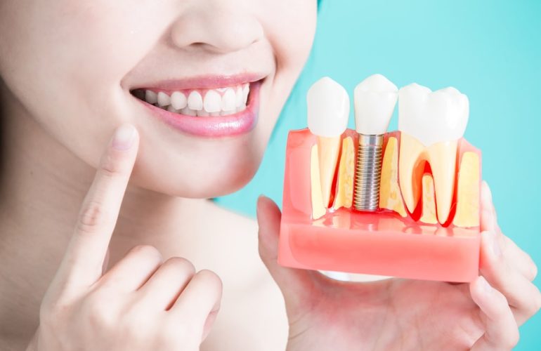 Affordable Dental Implants