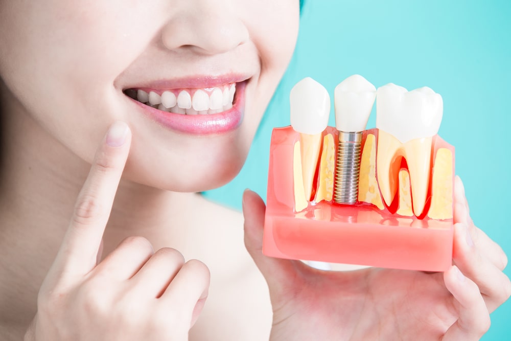 Affordable Dental Implants