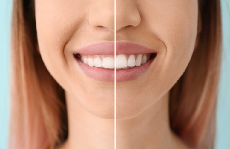 The Ultimate Guide to Gum Contouring