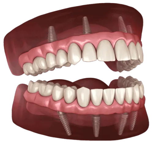 Full Mouth Reconstruction In Albania