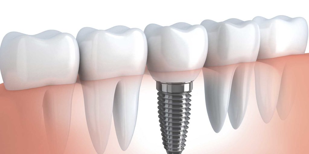 Impianti dentali All-on-4 in Albania: costi, procedura, vantaggi e guida completa