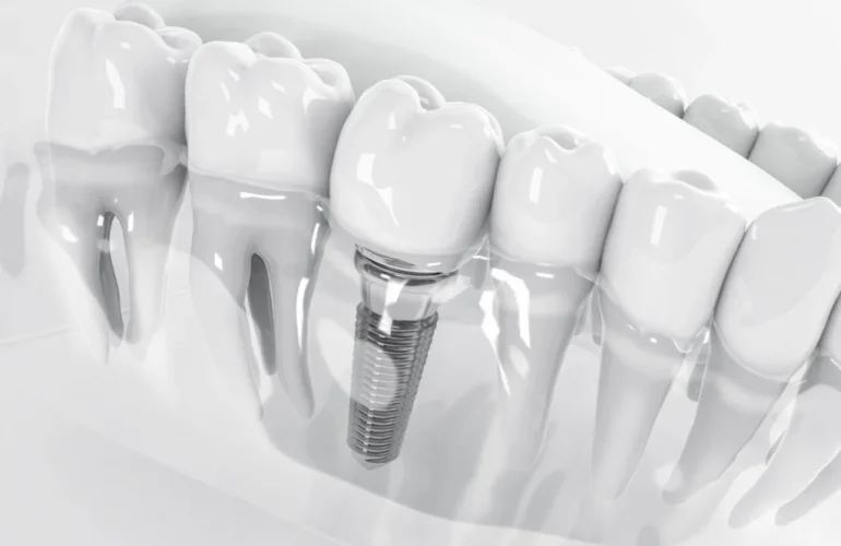Turkey vs Albania Dental Implants for UK Patients