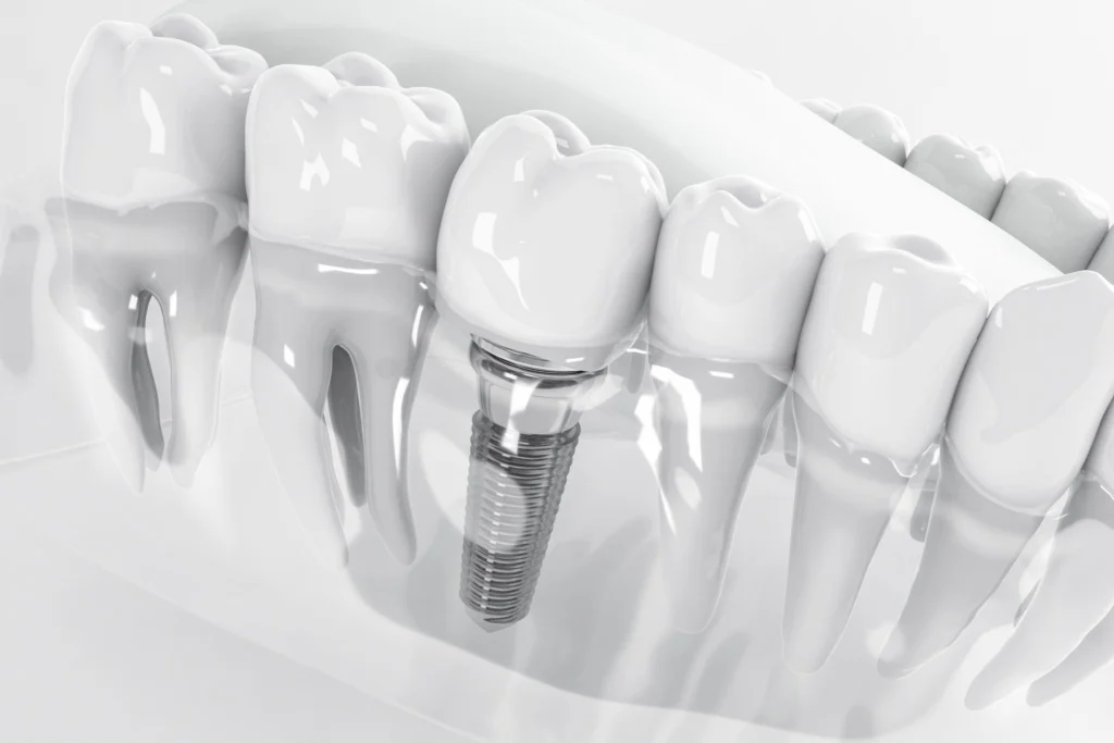 Turkey vs Albania Dental Implants for UK Patients