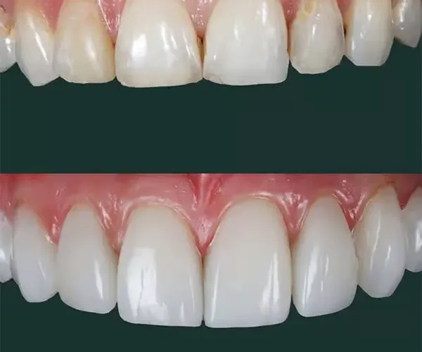 albania composite bonding