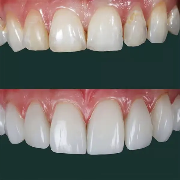 albania composite bonding