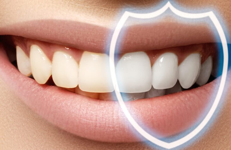 composite bonding