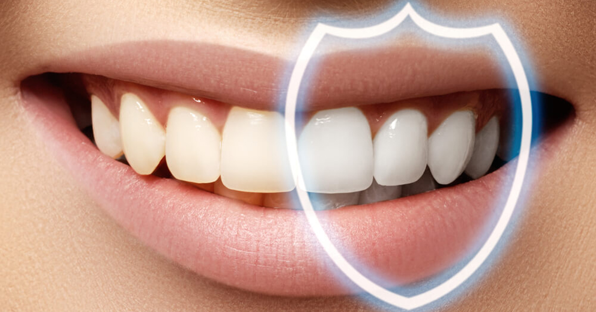 composite bonding