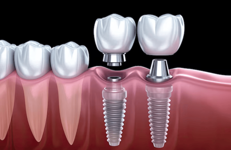 implante dentare
