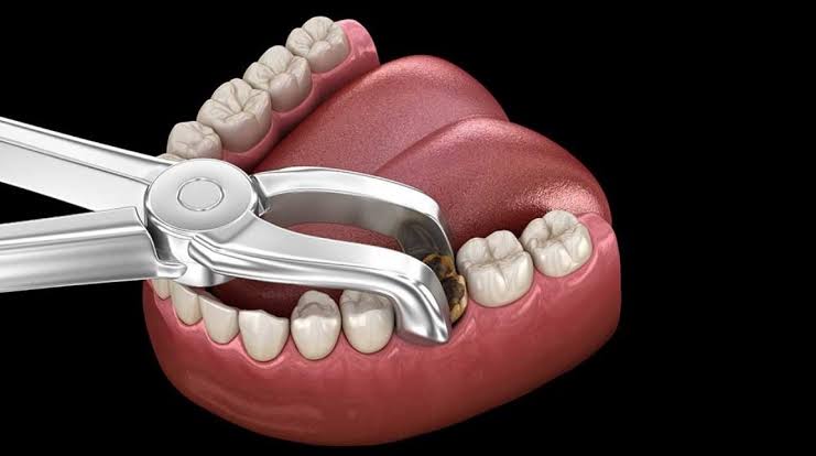 Quanto costa togliere un dente in Italia: estrazione semplice 80–200 €, chirurgica 200–600 €, dente del giudizio incluso da 200 €. Costi extra, SSN, detrazione del 19% e cosa fare dopo.
